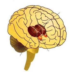 опухоли в таламусе