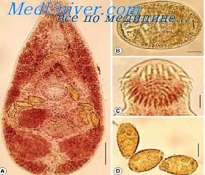 абдоминальный парагонимоз