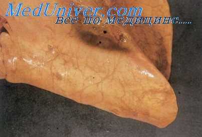 парагонимоз