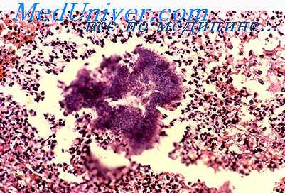 актинобациллез