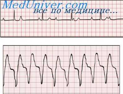 экг при алкоголизме