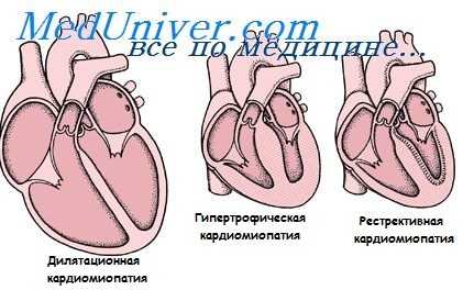алкогольная кардиомиопатия