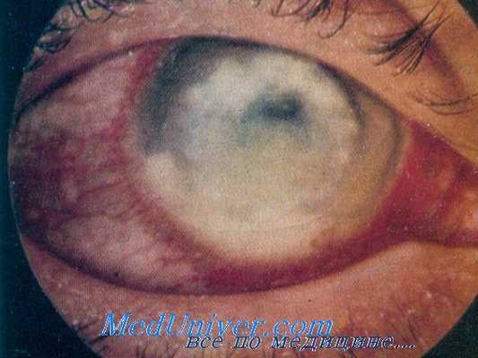 клиника амебиаза