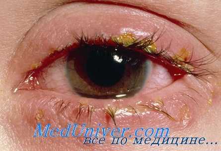 глаза при амебиазе