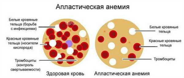Что такое апластическая анемия