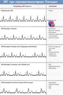 ЭКГ при атриовентрикулярных блокадах