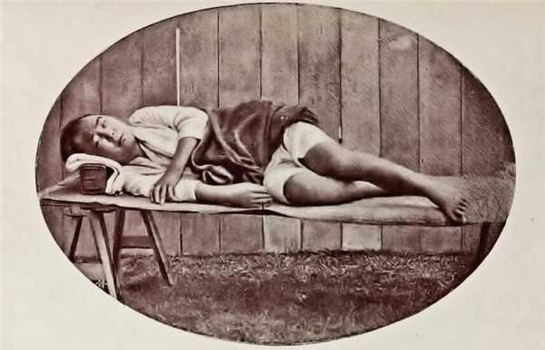 Больной с симптомами бери-бери