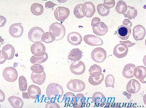 мазок крови при бета-талассемии