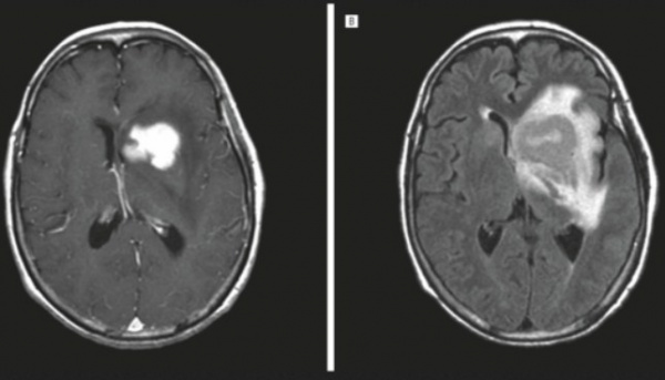 МРТ головного мозга. Лимфома ЦНС