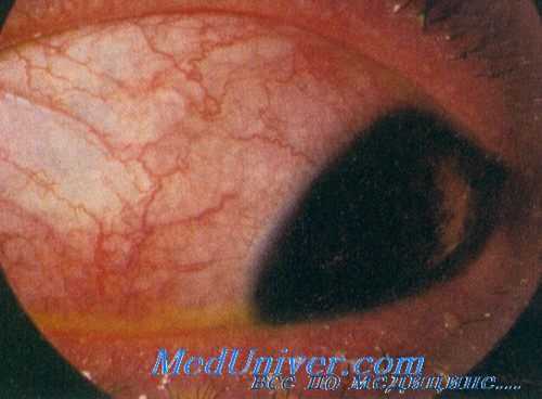 демодекоз глаз