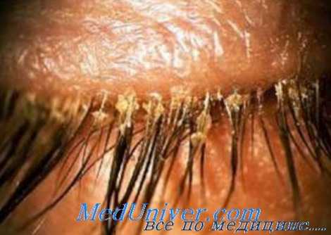 клиника демодекоза