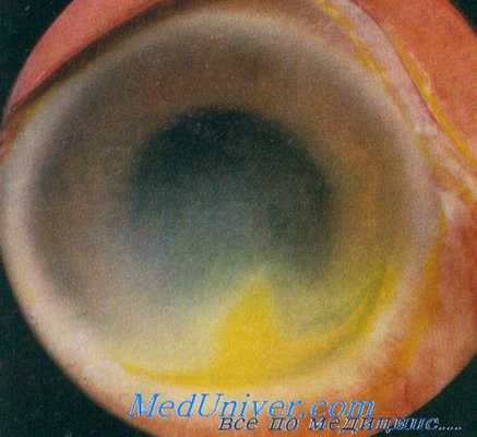 демодекоз глаз