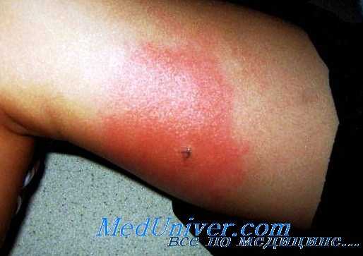 аллергия к укусам насекомых