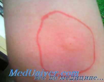 аллергия к насекомым у детей