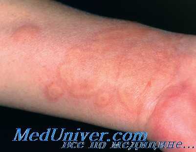 крапивница у детей