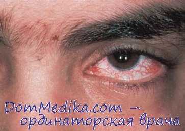 атаксия-телеангиэктазия