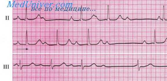 ЭКГ при синдроме Венкебаха