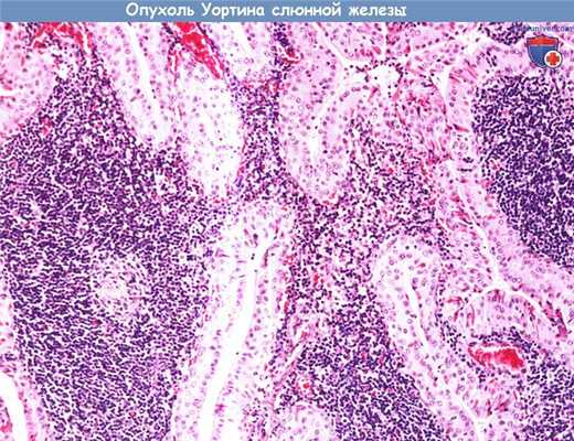 Цитология (гистология) слюнной железы при опухоли Уортина