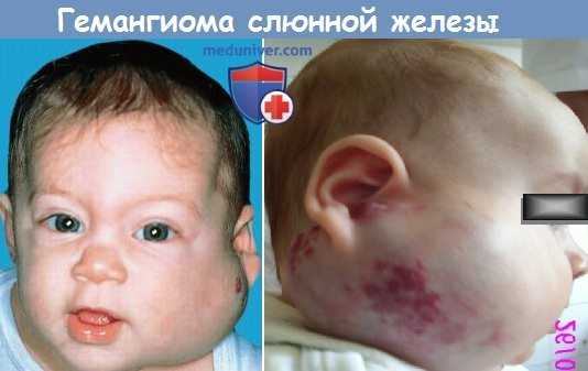 Гемангиома слюнной железы