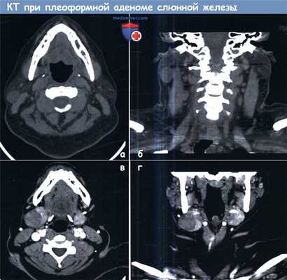 КТ при плеоформной аденоме слюнной железы
