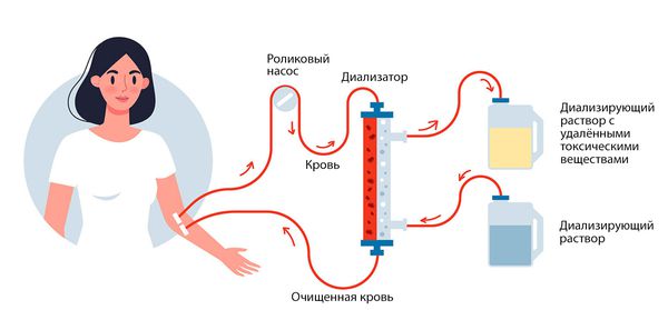 Гемодиализ