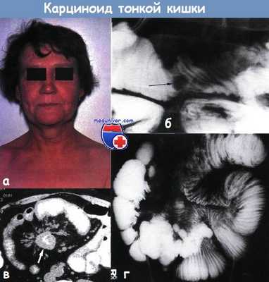 Карциноид тонкой кишки