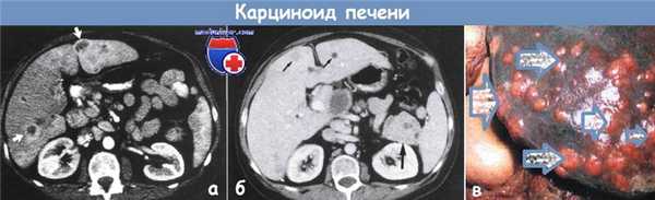 Карциноид печени
