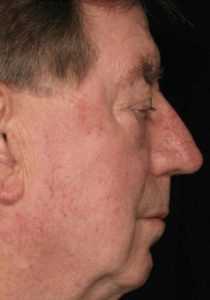 Рис. 5б. Фото после лечения актинического кератоза на лице лазером