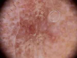 Рис. 1б. Дерматоскопия актинического кератоза