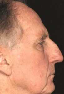 Рис. 4б. Фото после лечения актинического кератоза на лице лазером