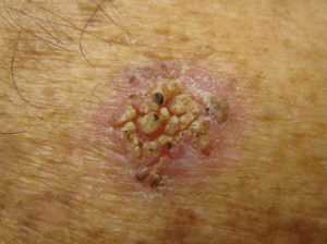 Рис. 1а. Актинический кератоз