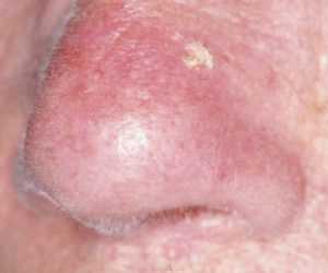 Рис. 3б. Актинический кератоз на носу