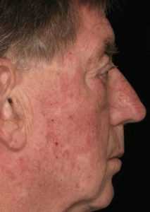 Рис. 5а. Фото до лечения актинического кератоза на лице лазером