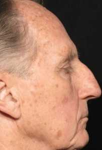 Рис. 4а. Фото до лечения актинического кератоза на лице лазером