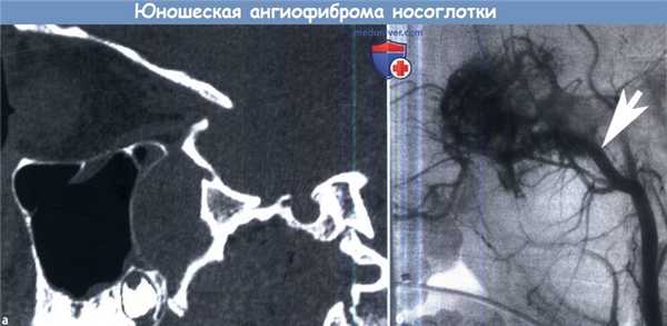 КТ и ангиография при юношеской ангиофиброме носоглотки