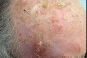 Рис. 3а. Актинический кератоз головы