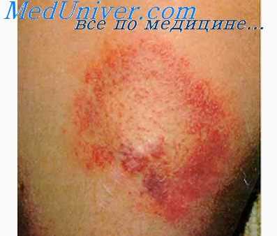 лихорадка скалистых гор