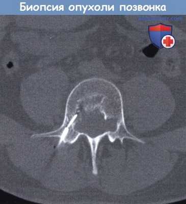 Биопсия опухоли позвонка