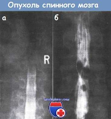 Опухоль спинного мозга