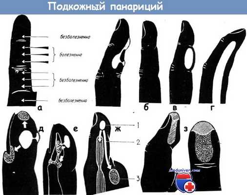 Подкожный панариций