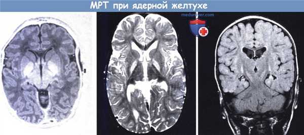 МРТ при ядерной желтухе