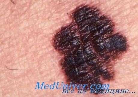 Злокачественная меланома - внешний вид