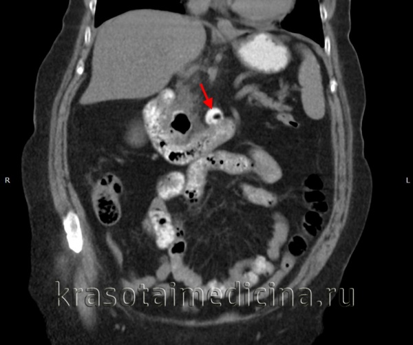 Дивертикулит