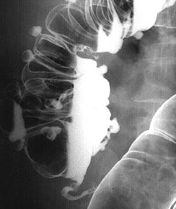 Дивертикулы кишечника (рентгенограмма с барием)