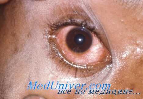 эхинококк глаза