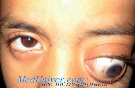 клиника эхинококкоза