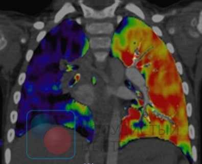 Сцинтиграфия легких