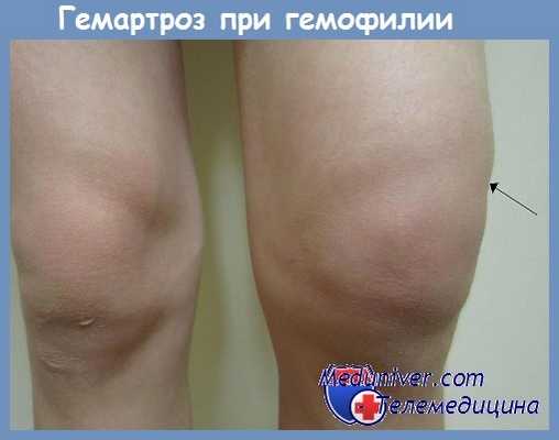 гемартроз при гемофилии
