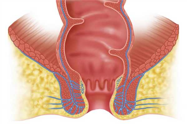 Гипертрофированные анальные сосочки — лечение воспаления, симптомы, диагностика, терапия