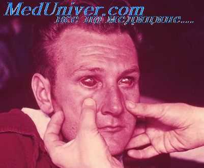 Глаза при геморрагической лихорадксе с почечным синдромом (ГЛПС, мышиной лихорадке)